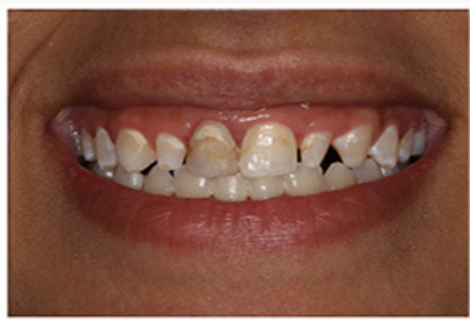 After orthodontic treatment