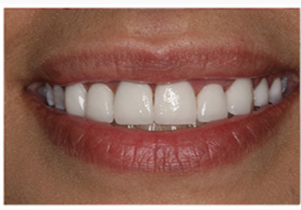 Before orthodontic treatment