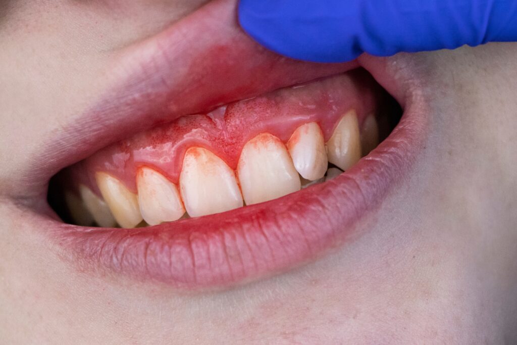 Gum disease